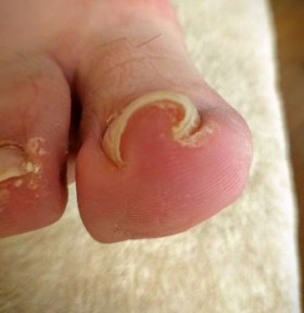 左足親指の矯正前の巻き爪