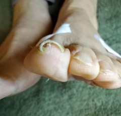 矯正前の左足親指の巻き爪
