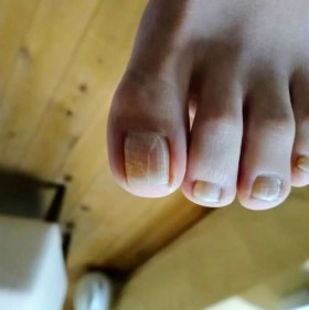 矯正前の左足親指の爪正面