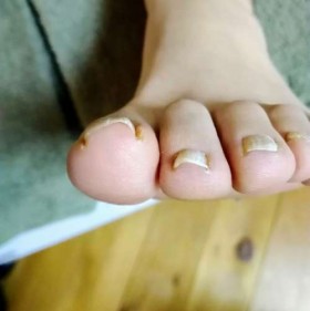 矯正前の左足親指の爪