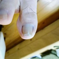 矯正前の右足親指の爪