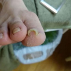 矯正前の右足親指
