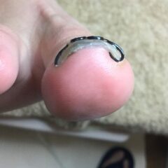 ツメフラ装具で巻き込みを整えた右足親指の巻き爪矯正後
