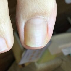 皮膚側へ巻き込んだ右足親指の爪を正面から確認した矯正前写真