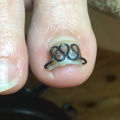 爪が皮膚へ当たっていた跡