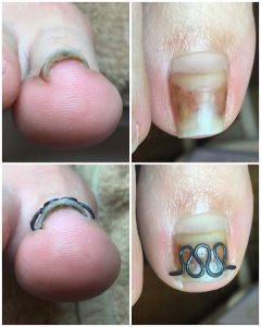 矯正前後の比較写真