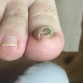 【巻き爪】矯正前