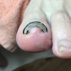 矯正後