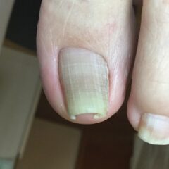 矯正前