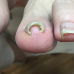 矯正前
