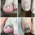 【巻き爪】ビフォーアフター写真