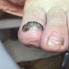 矯正後