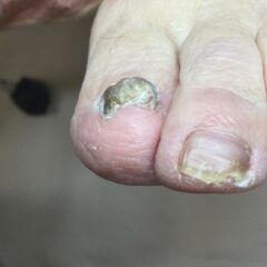 矯正前