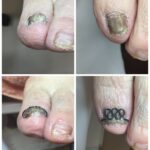【巻き爪】ビフォーアフター写真