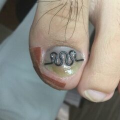 矯正後