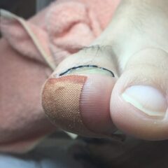 矯正後