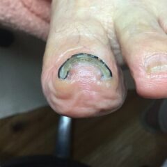矯正後