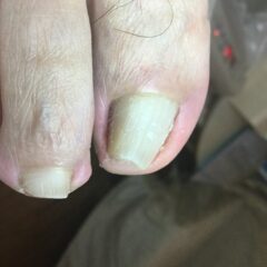 矯正前