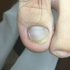 矯正前