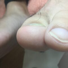 矯正前