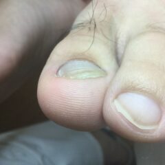 矯正前