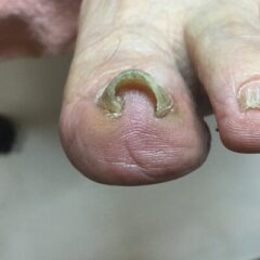 矯正前