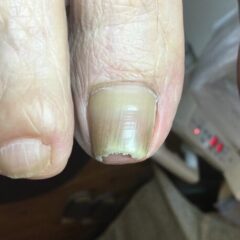 矯正前