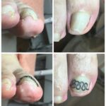 【巻き爪】ビフォーアフター写真