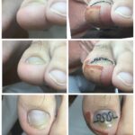 【巻き爪】ビフォーアフター写真