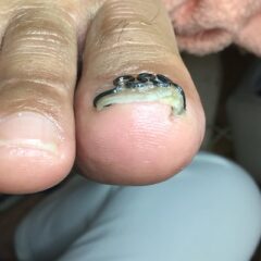 矯正後