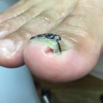 【巻き爪】食い込みの跡