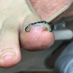 矯正後