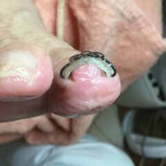 矯正後