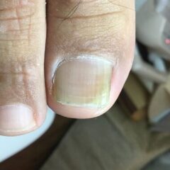 矯正前