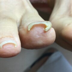 矯正前
