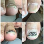 【巻き爪】ビフォーアフター写真