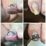 【巻き爪】ビフォーアフター写真