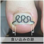 【巻き爪】食い込みの跡