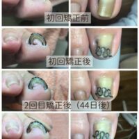 3回の矯正のビフォーアフター写真