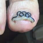 【巻き爪】食い込みの跡