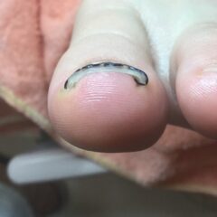 矯正後