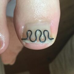矯正後
