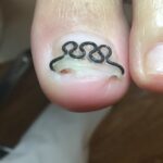 【巻き爪】食い込みの跡