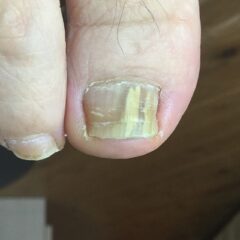 矯正前