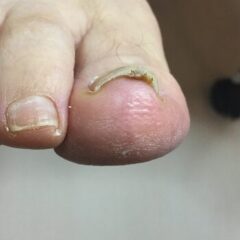 矯正前