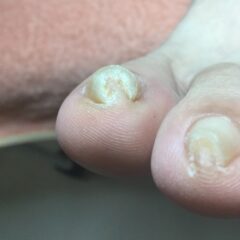 矯正前