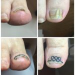 【巻き爪】ビフォーアフター写真