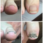 【巻き爪】ビフォーアフター写真