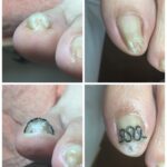 【巻き爪】ビフォーアフター写真