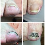 【巻き爪】ビフォーアフター写真